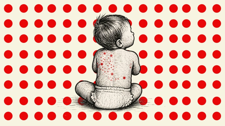 4 More Die with Measles-Like Symptoms, Combined Toll Reaches 1,057