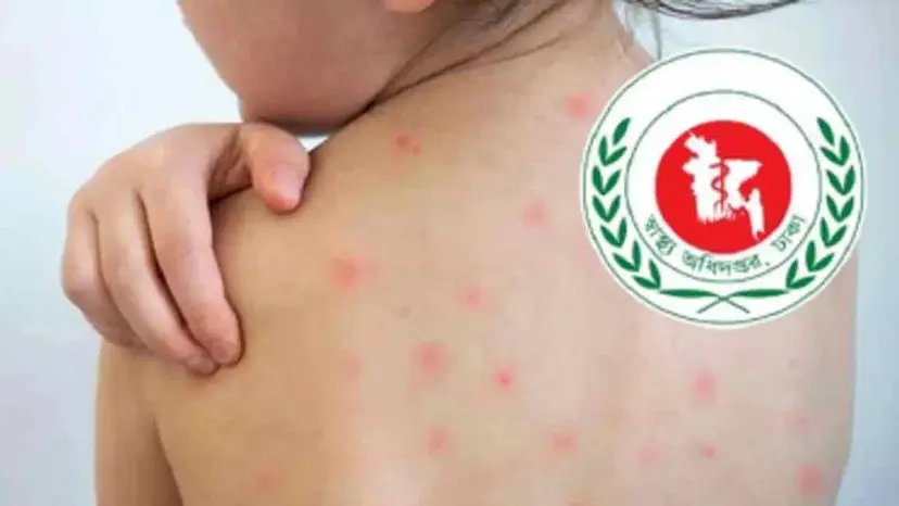Three More Suspected Measles Deaths Reported in 24 Hours, National Death Toll Reaches 1,125